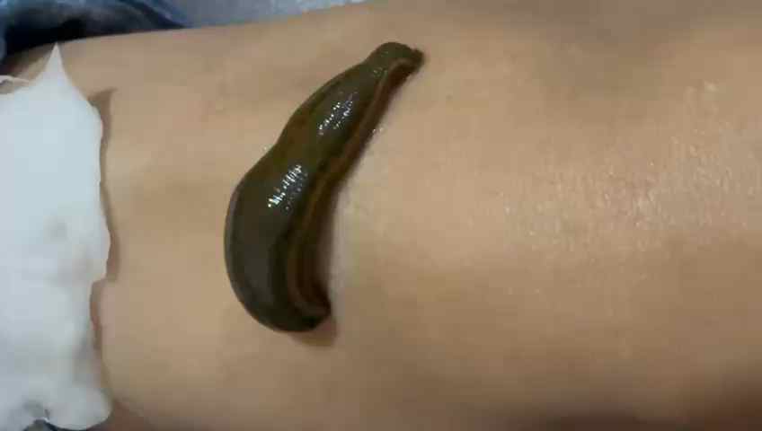 Jalaukacharan (leech therapy)